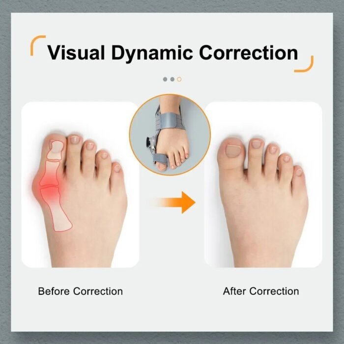 Ultimate Comfort Bunion Corrector - Adjustable Toe Straightener & Hallux Valgus Relief - Image 4